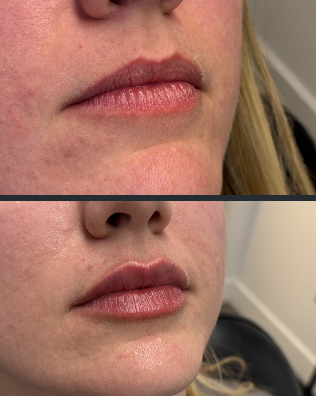 Lip filler before and after at Everyday Beauty Med Spa