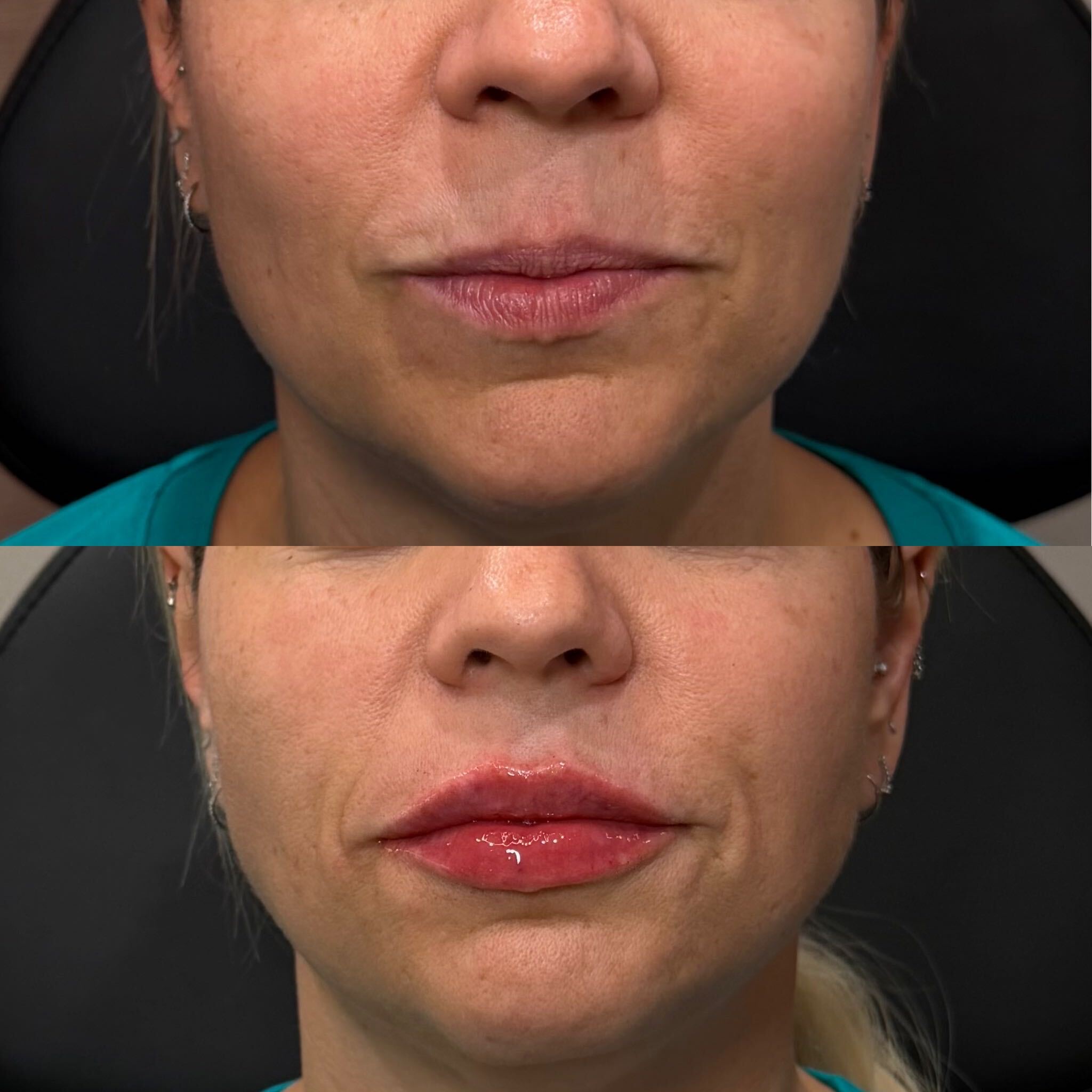 Lip filler before and after at Everyday Beauty Med Spa