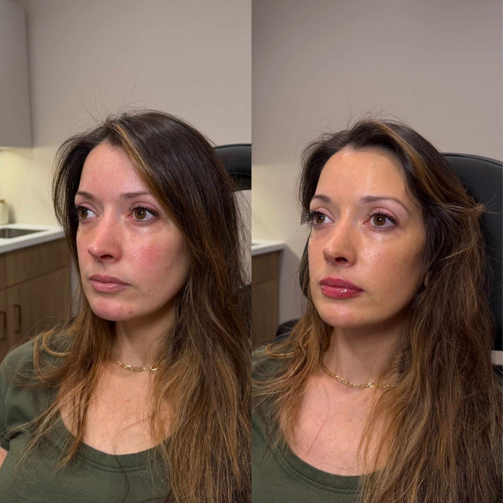 Lip filler before and after at Everyday Beauty Med Spa