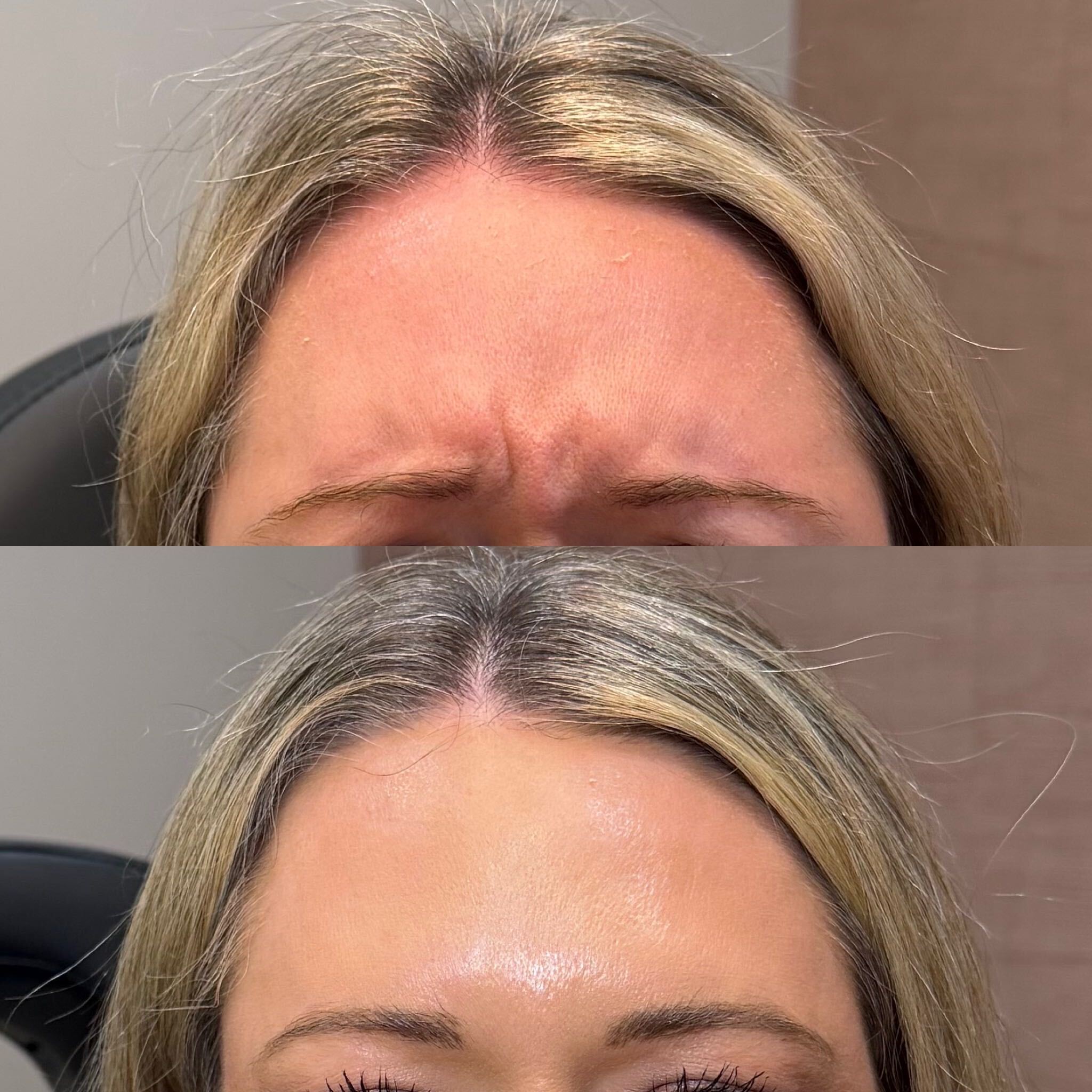 Neurotoxin before and after at Everyday Beauty Med Spa