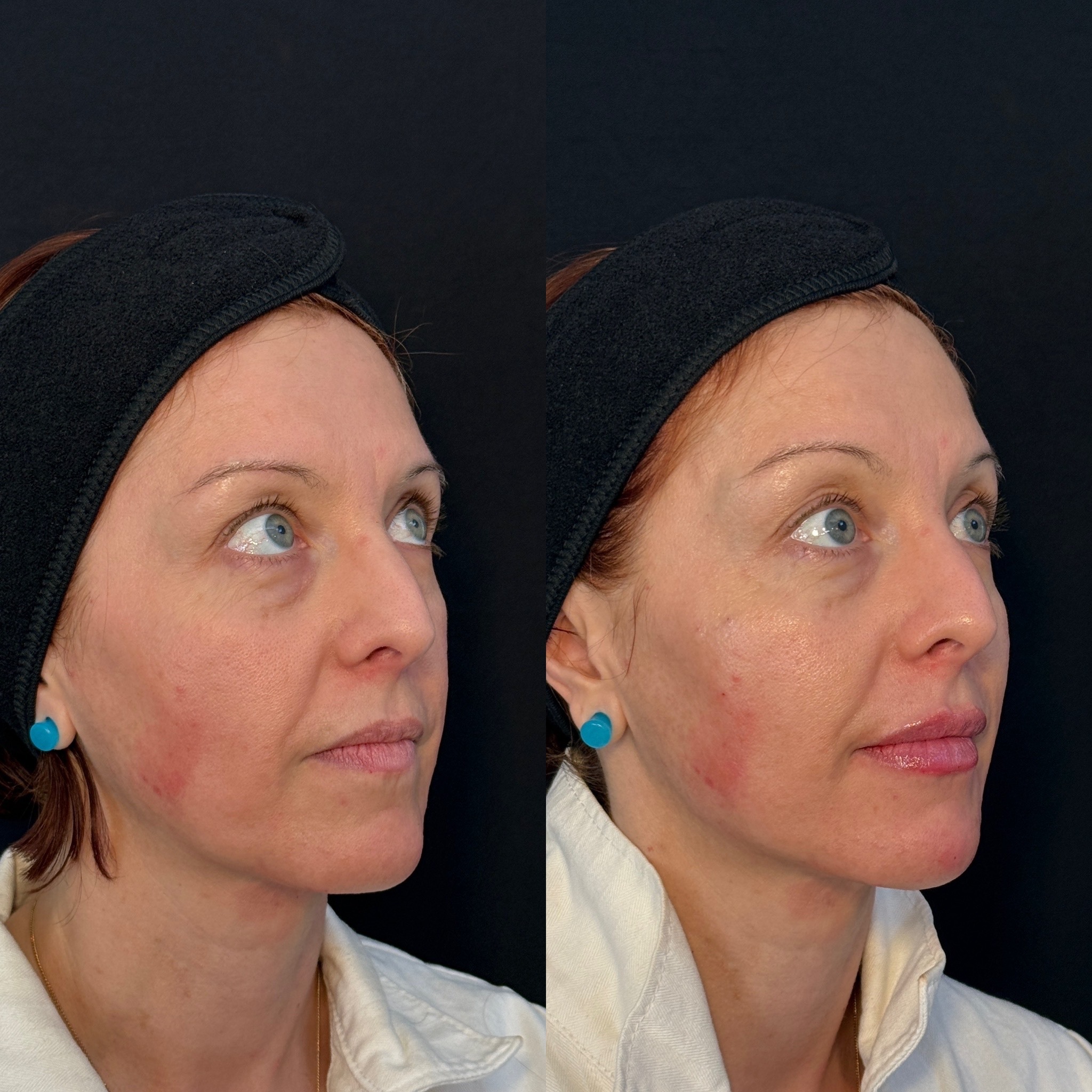 Skin rejuvenation before and after at Everyday Beauty Med Spa
