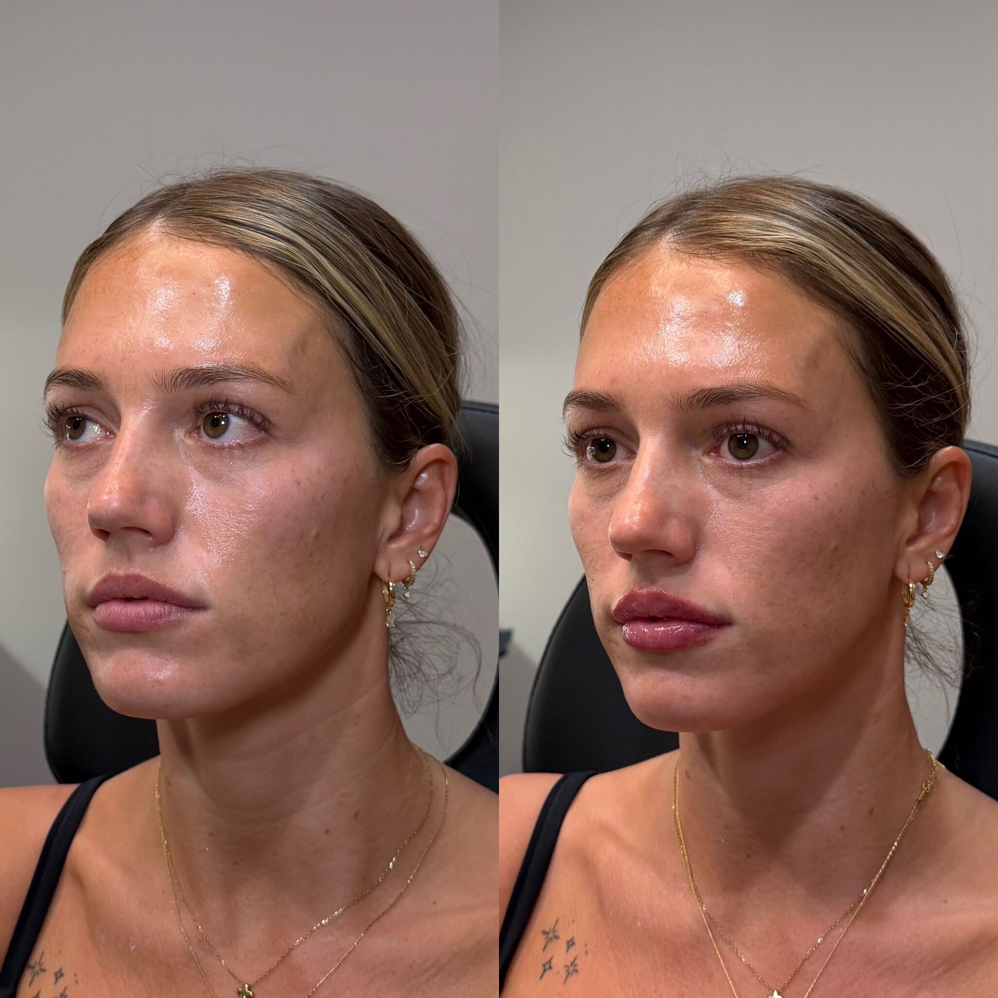 Lip filler before and after at Everyday Beauty Med Spa