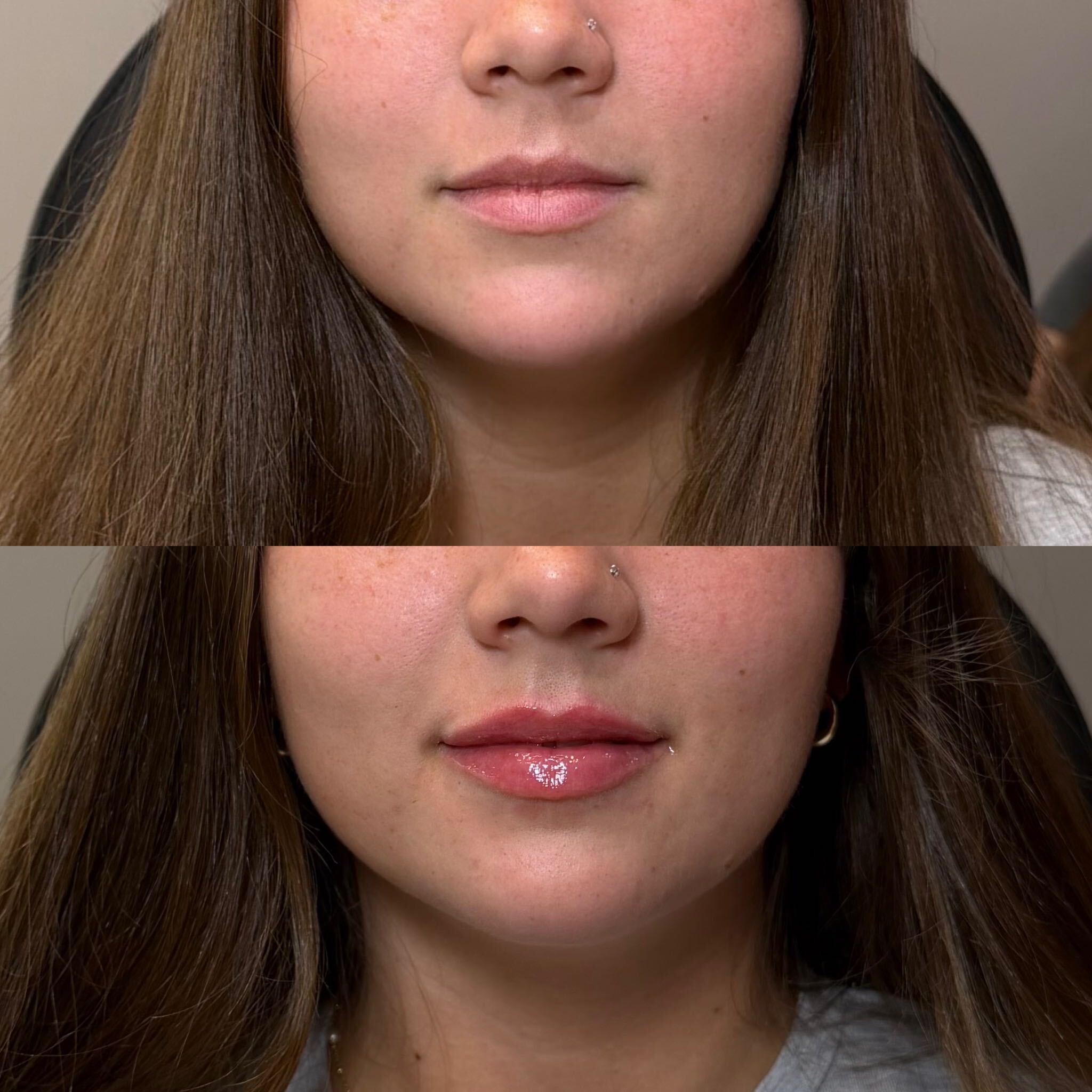Lip filler before and after at Everyday Beauty Med Spa