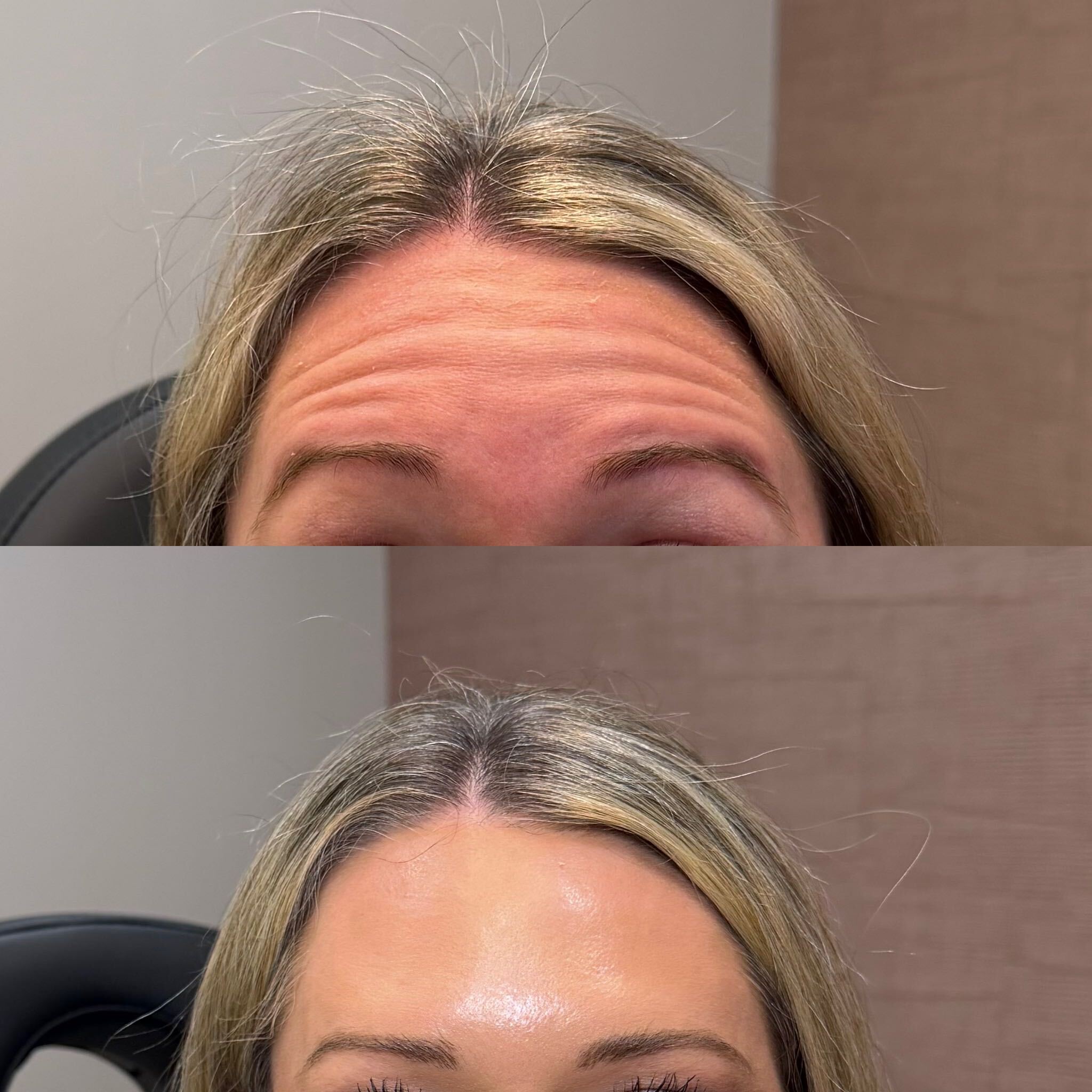 Neurotoxin before and after at Everyday Beauty Med Spa