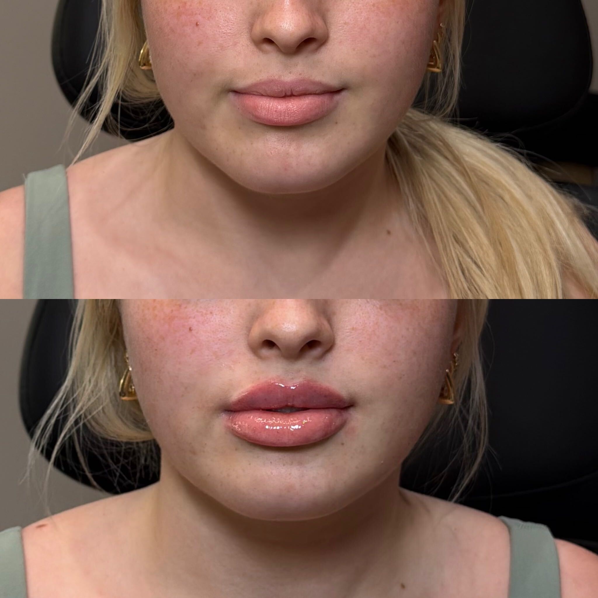 Lip filler before and after at Everyday Beauty Med Spa