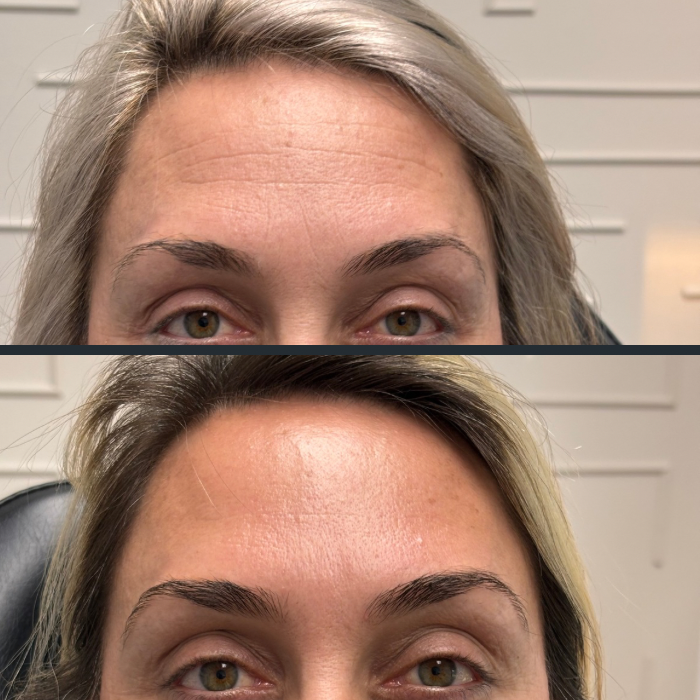 Neurotoxin before and after at Everyday Beauty Med Spa