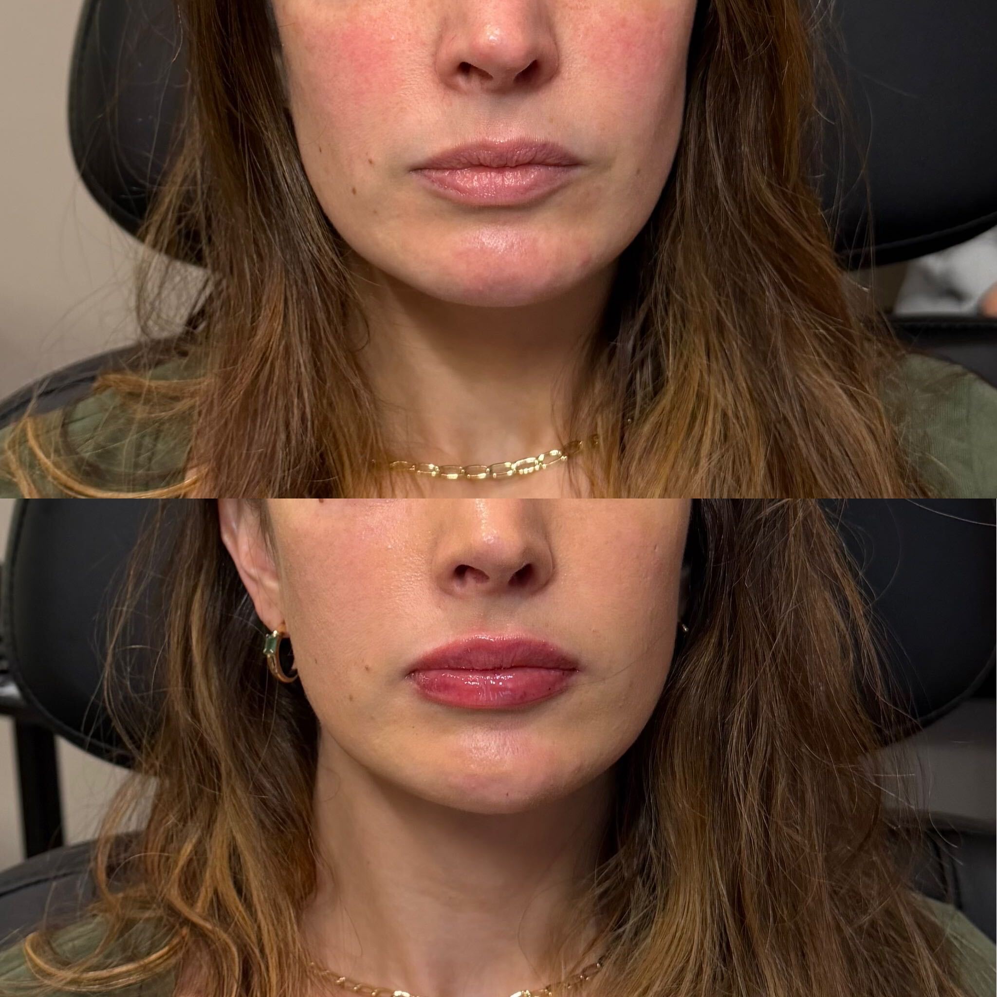 Lip filler before and after at Everyday Beauty Med Spa