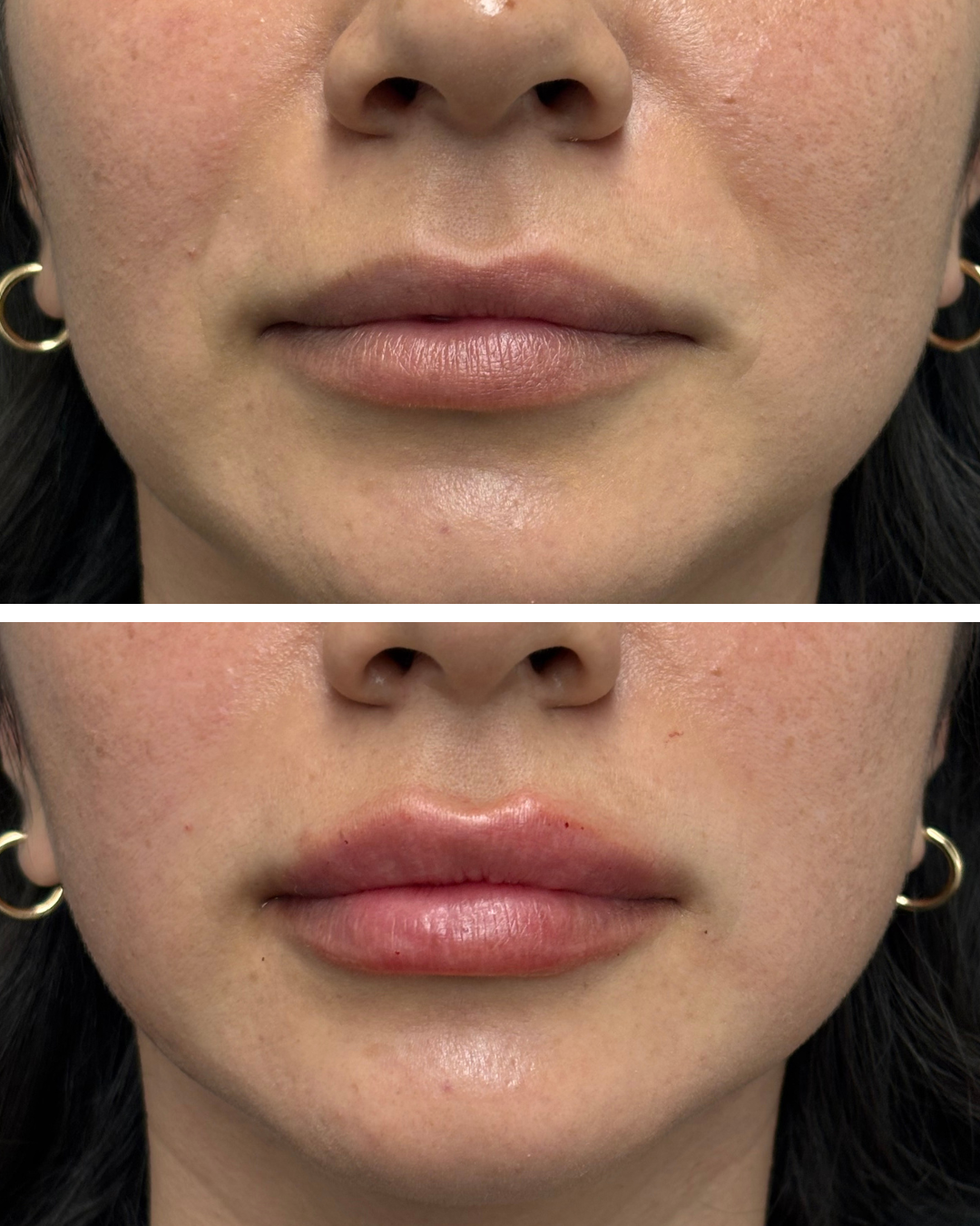 Lip filler before and after at Everyday Beauty Med Spa