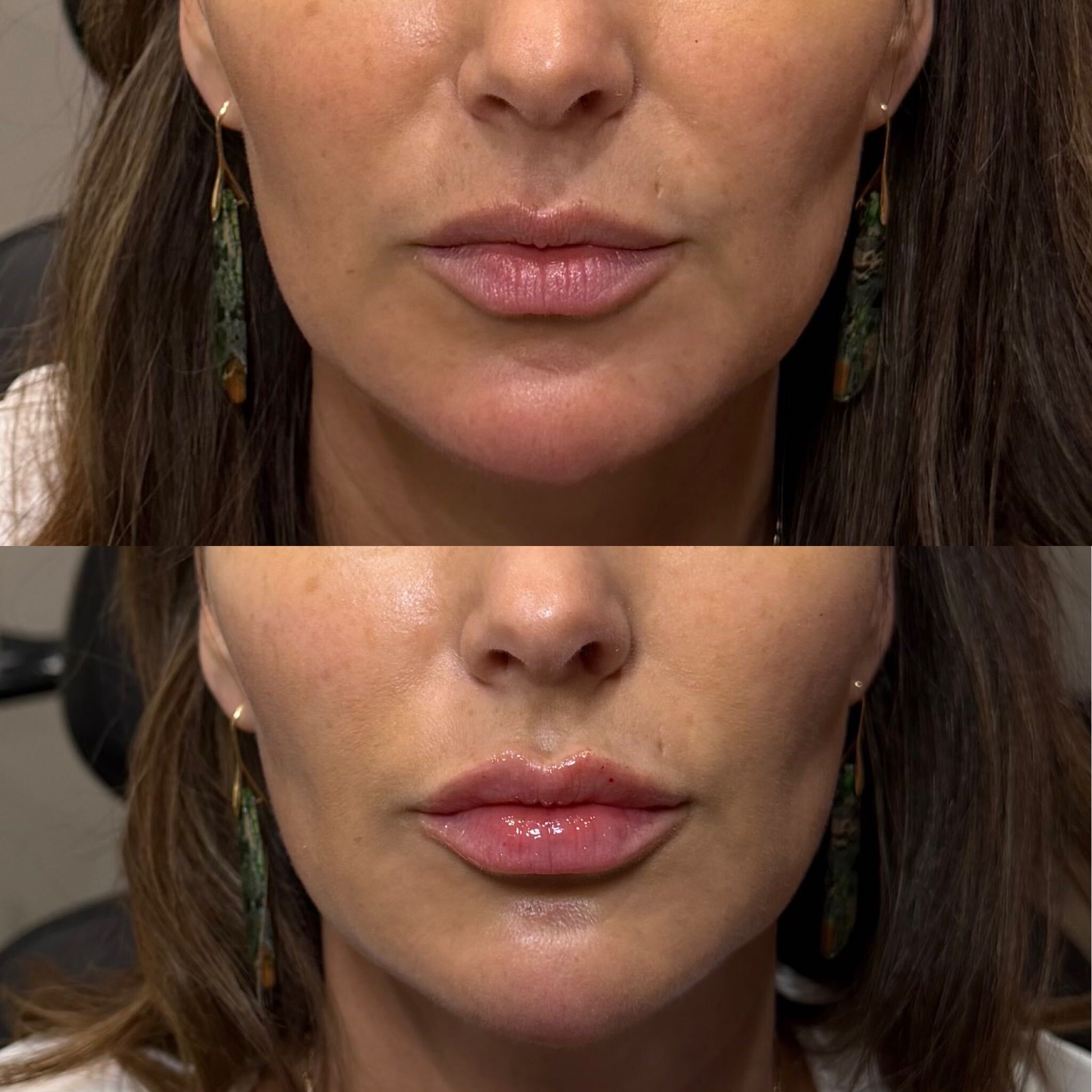 Lip filler before and after at Everyday Beauty Med Spa