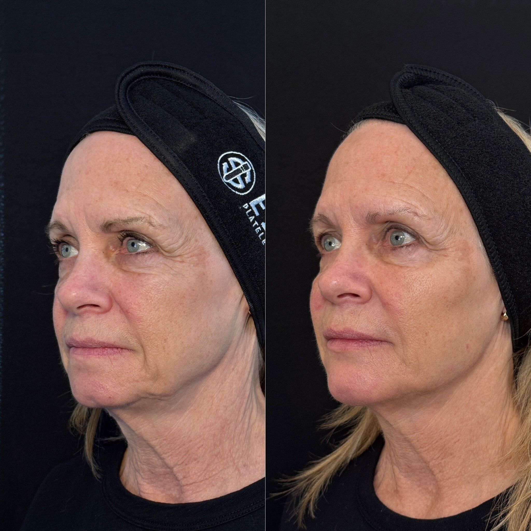 Skin rejuvenation before and after at Everyday Beauty Med Spa