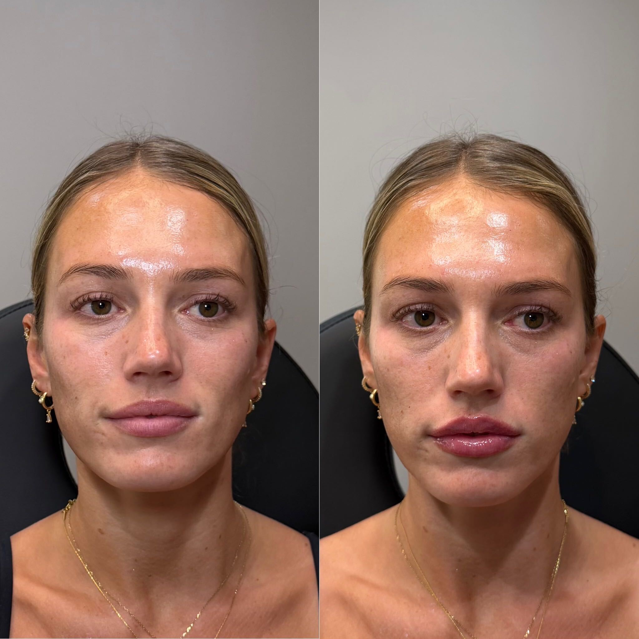 Lip filler before and after at Everyday Beauty Med Spa