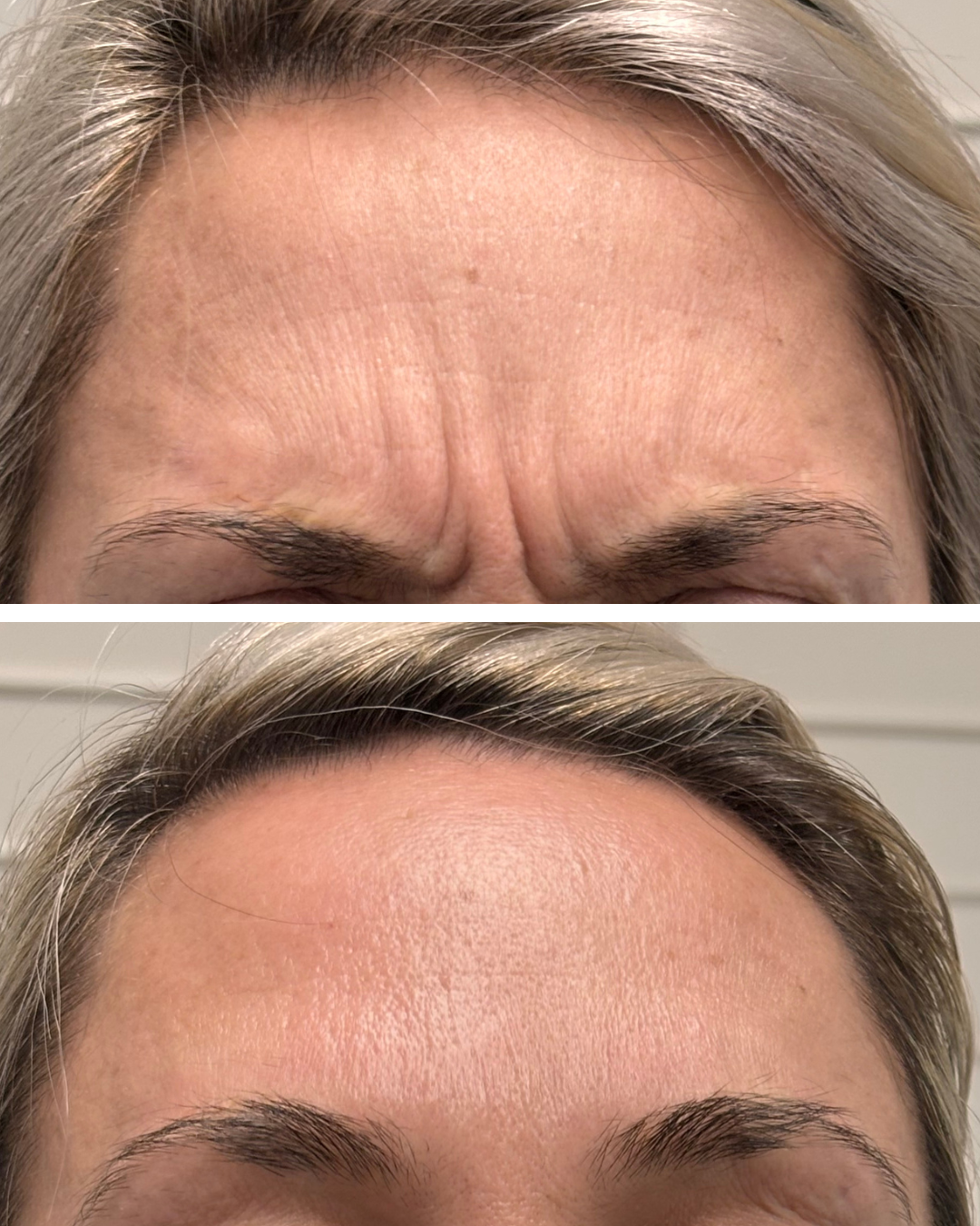 Neurotoxin before and after at Everyday Beauty Med Spa