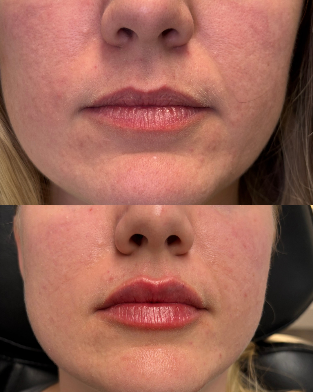 Lip filler before and after at Everyday Beauty Med Spa