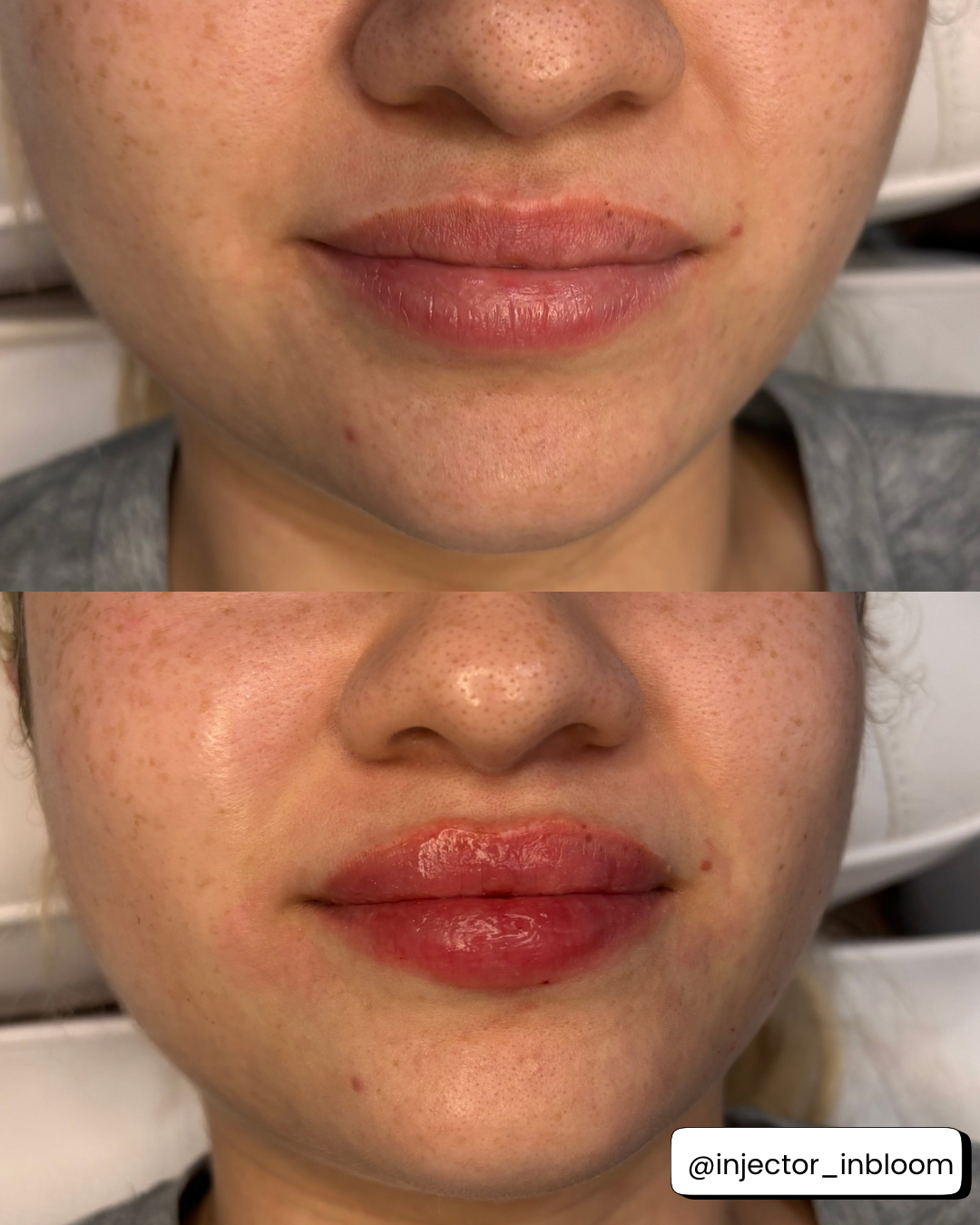 Lip filler before and after at Everyday Beauty Med Spa
