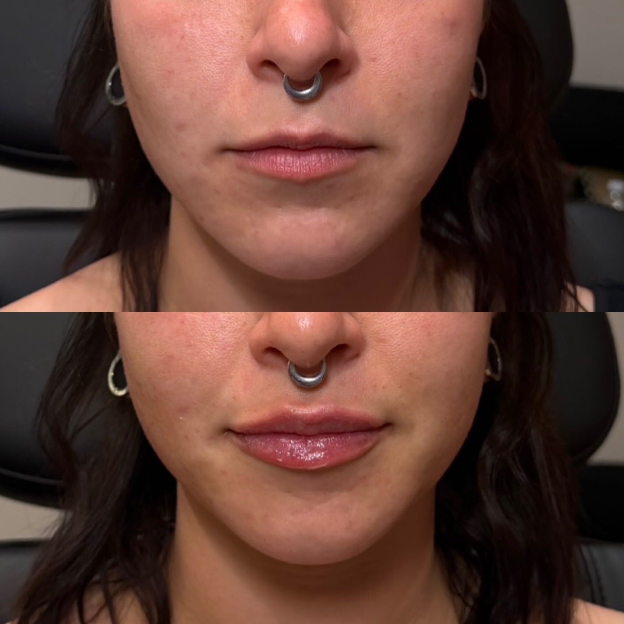 Lip filler before and after at Everyday Beauty Med Spa