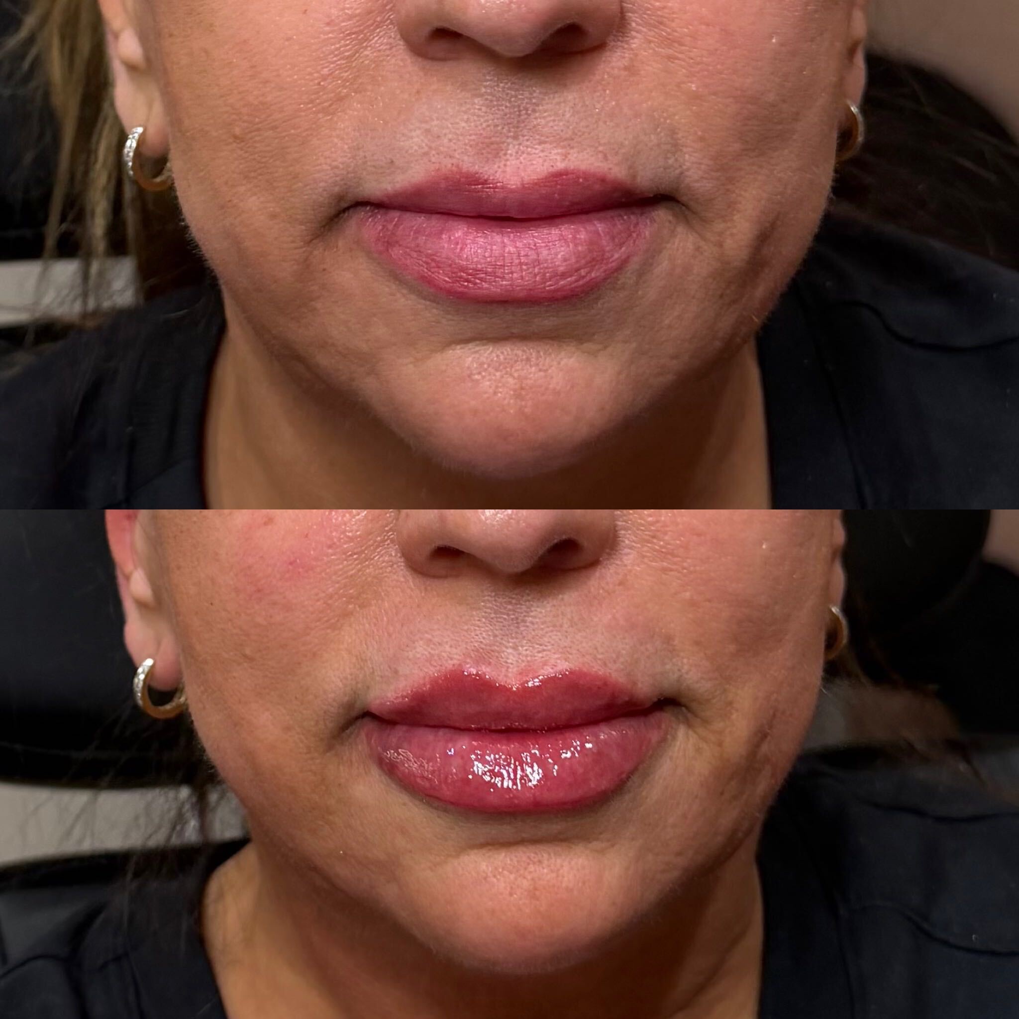 Lip filler before and after at Everyday Beauty Med Spa
