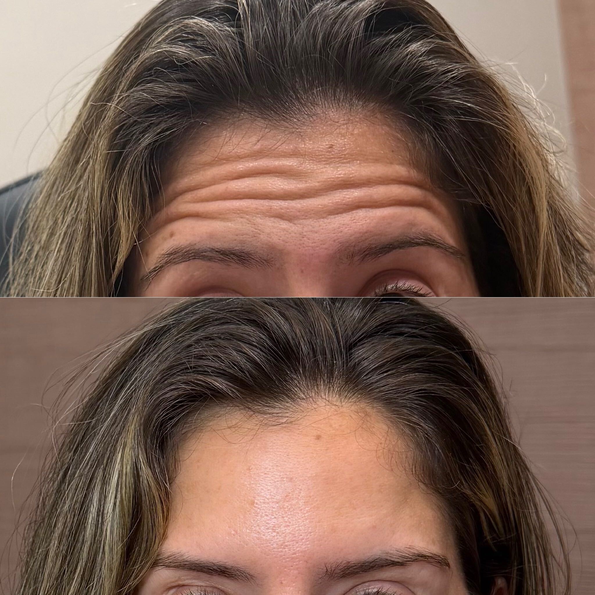 Neurotoxin before and after at Everyday Beauty Med Spa