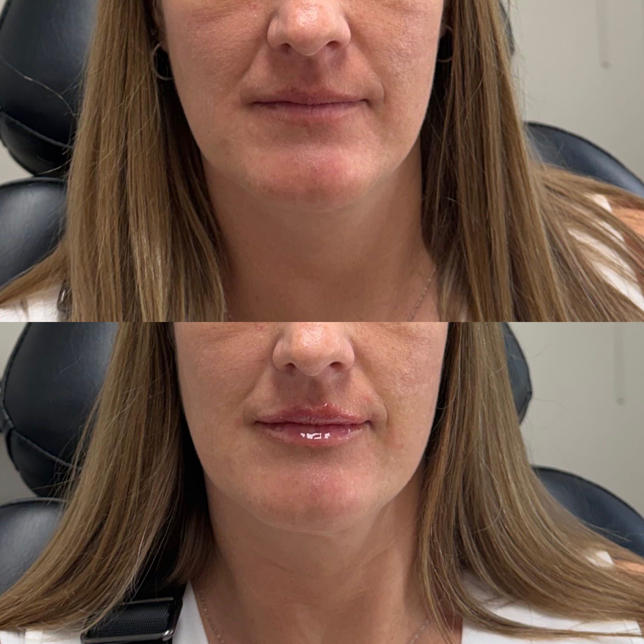 Lip filler before and after at Everyday Beauty Med Spa