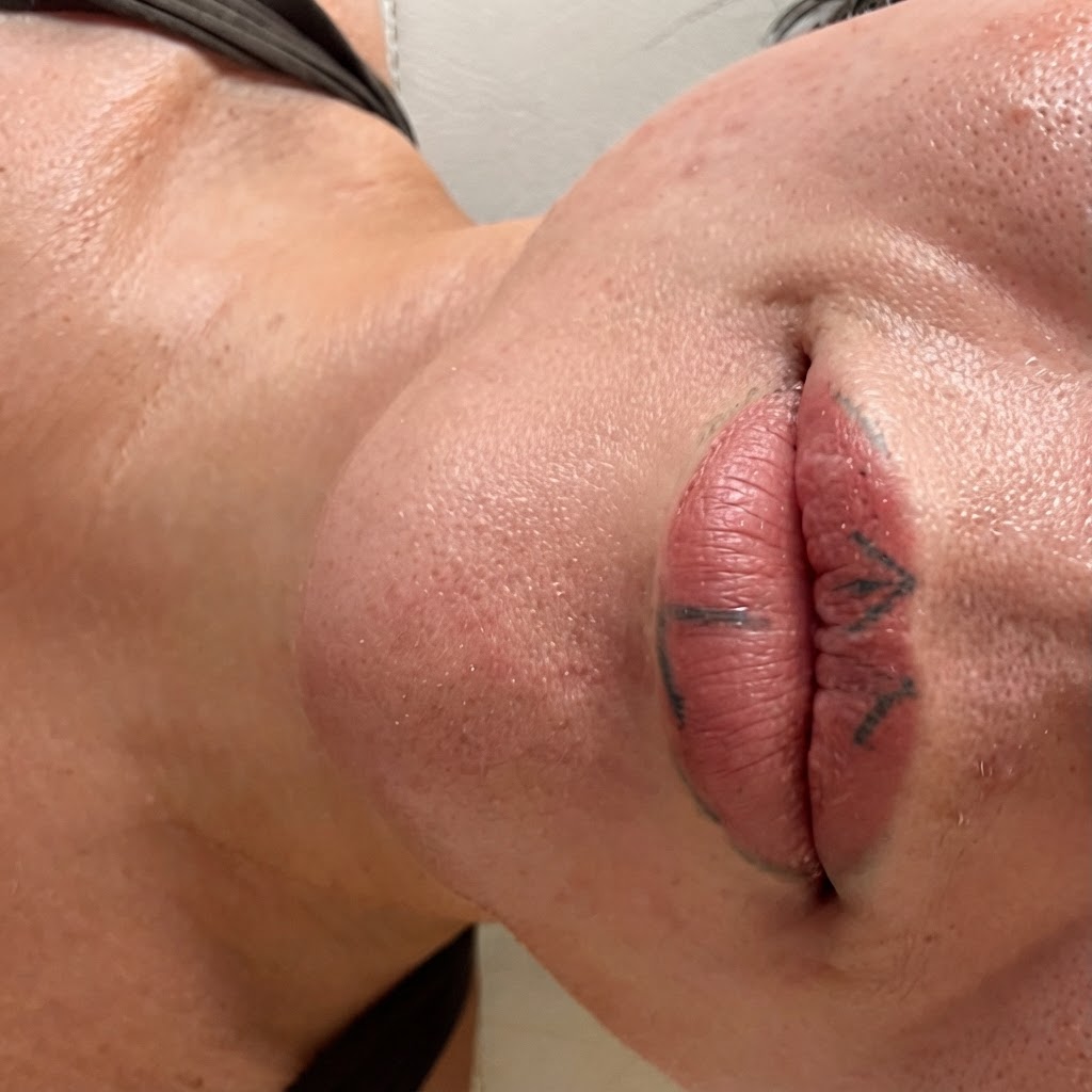 Lip Enhancement before