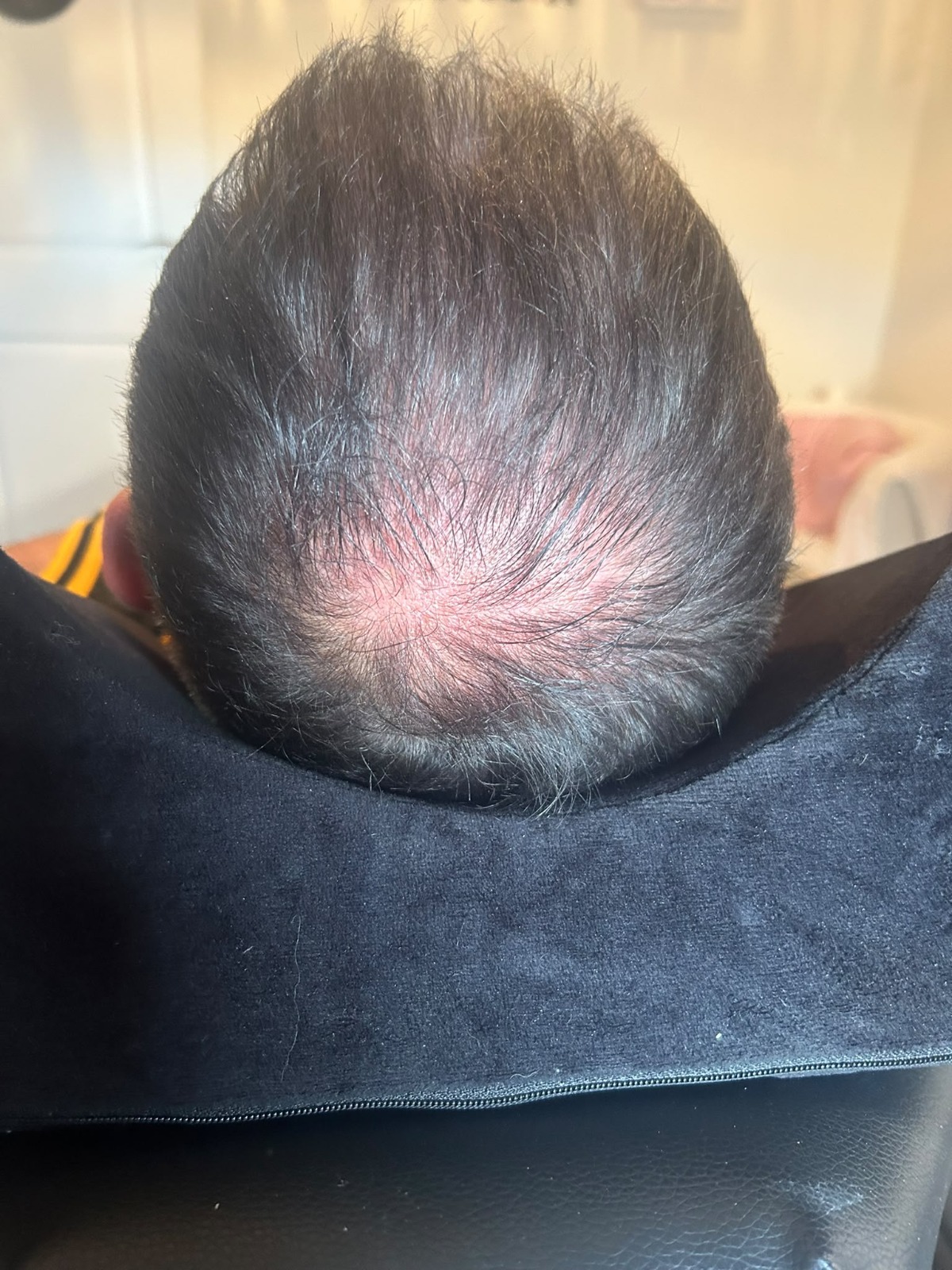 Exobloom Scalp Crown Density before
