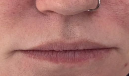 Lip Enhancement before