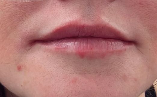 Lip Enhancement after