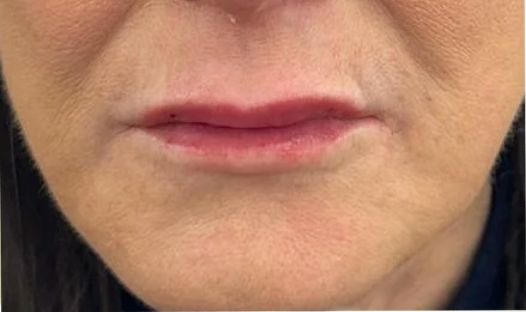 Lip Enhancement after