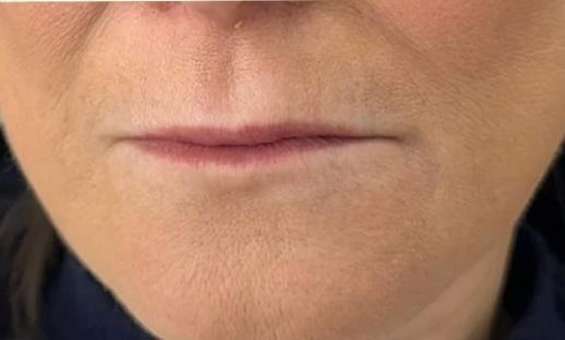 Lip Enhancement before