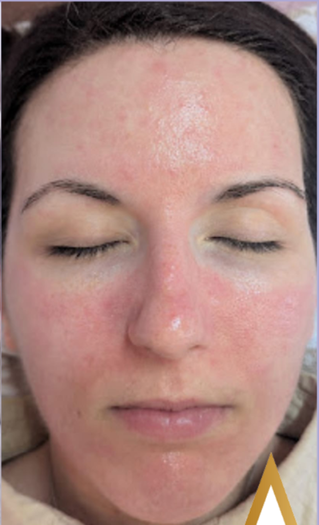 Microdermabrasion before