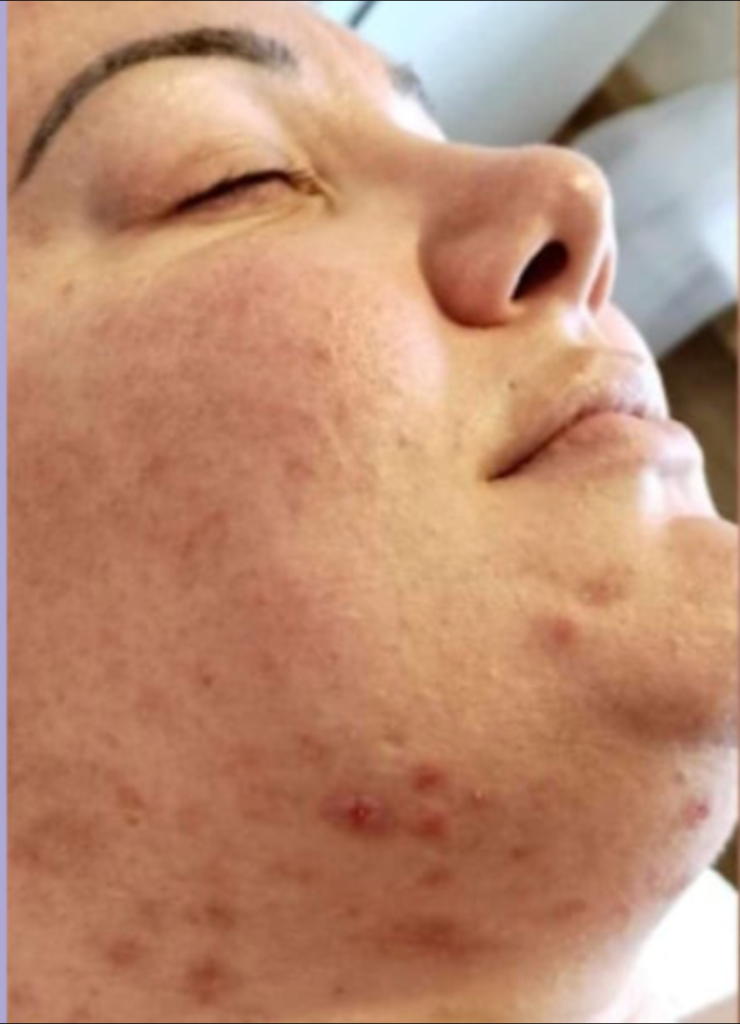 Microdermabrasion before