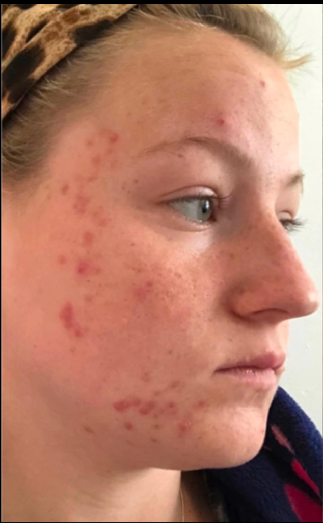 Microdermabrasion before