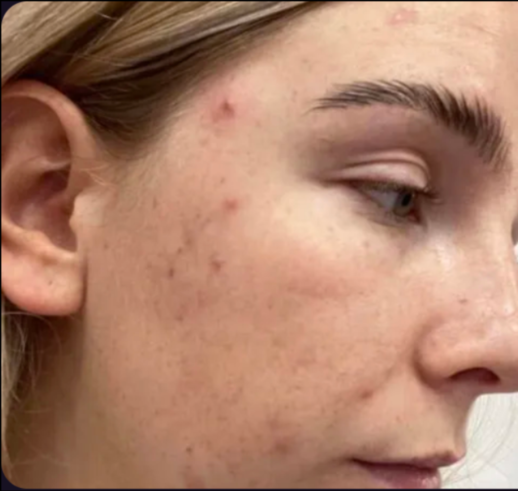Microdermabrasion before