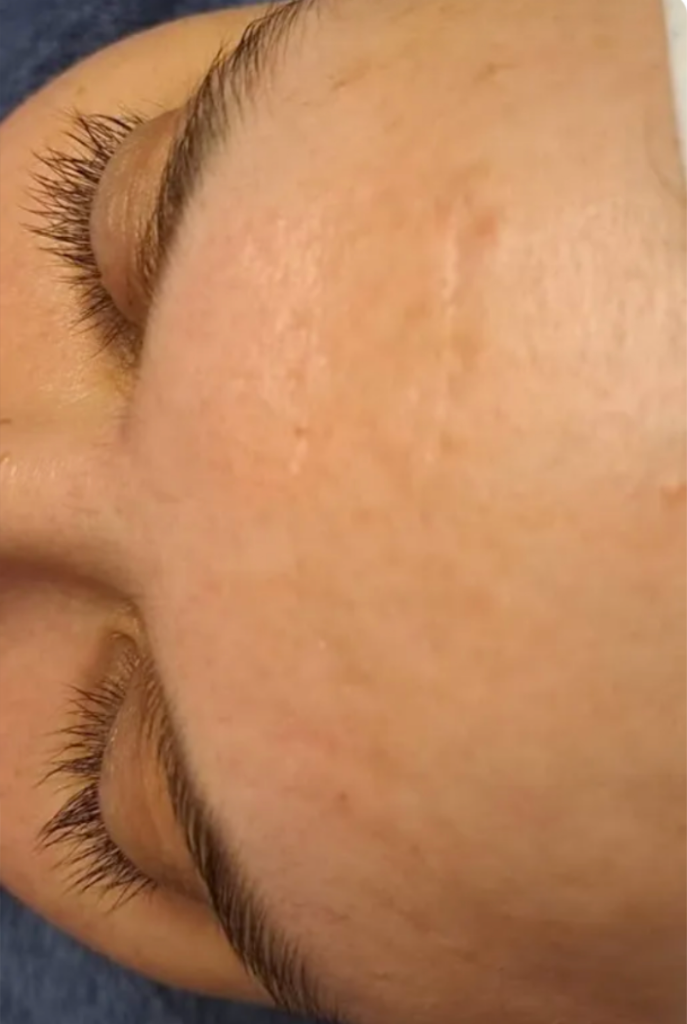 Microneedling after