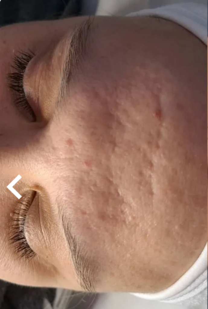 Microneedling before