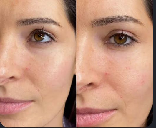 Skin Quality Improvement before and after