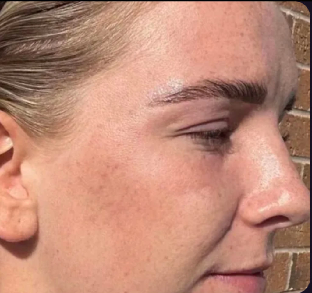 Microdermabrasion after