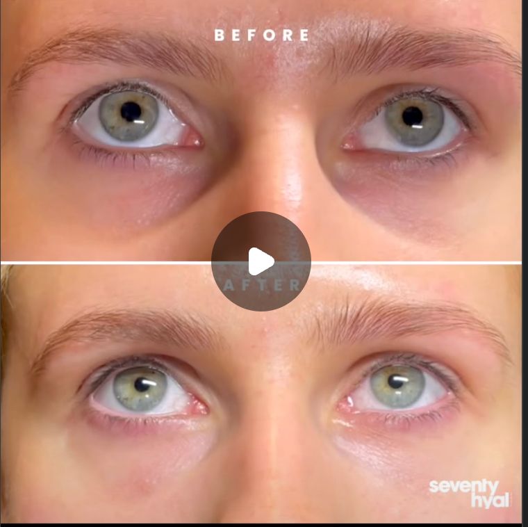 Eye Area Brightening before and after