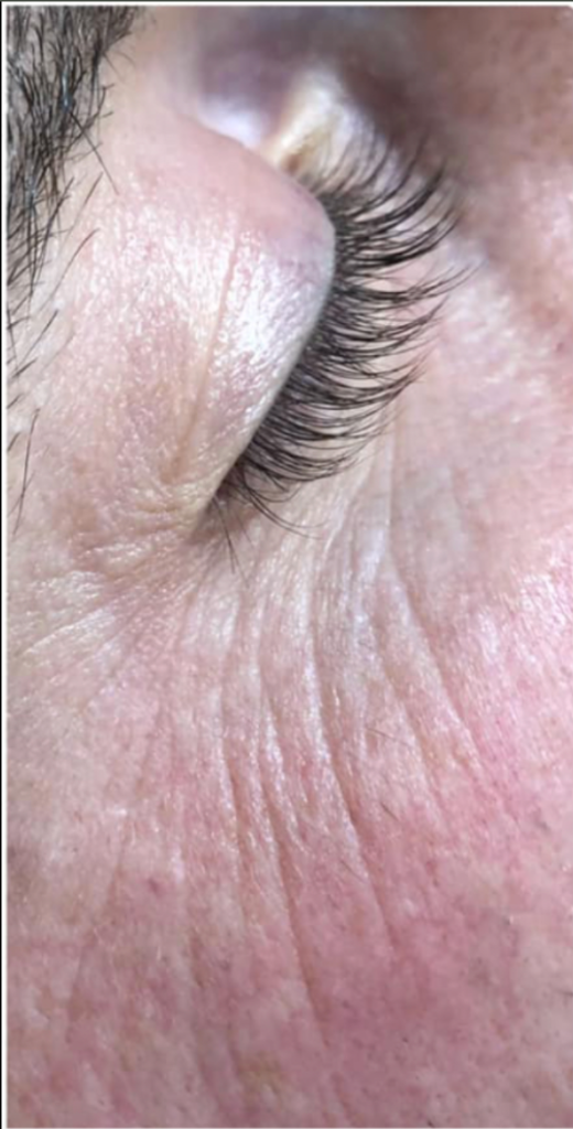 Crow's Feet before