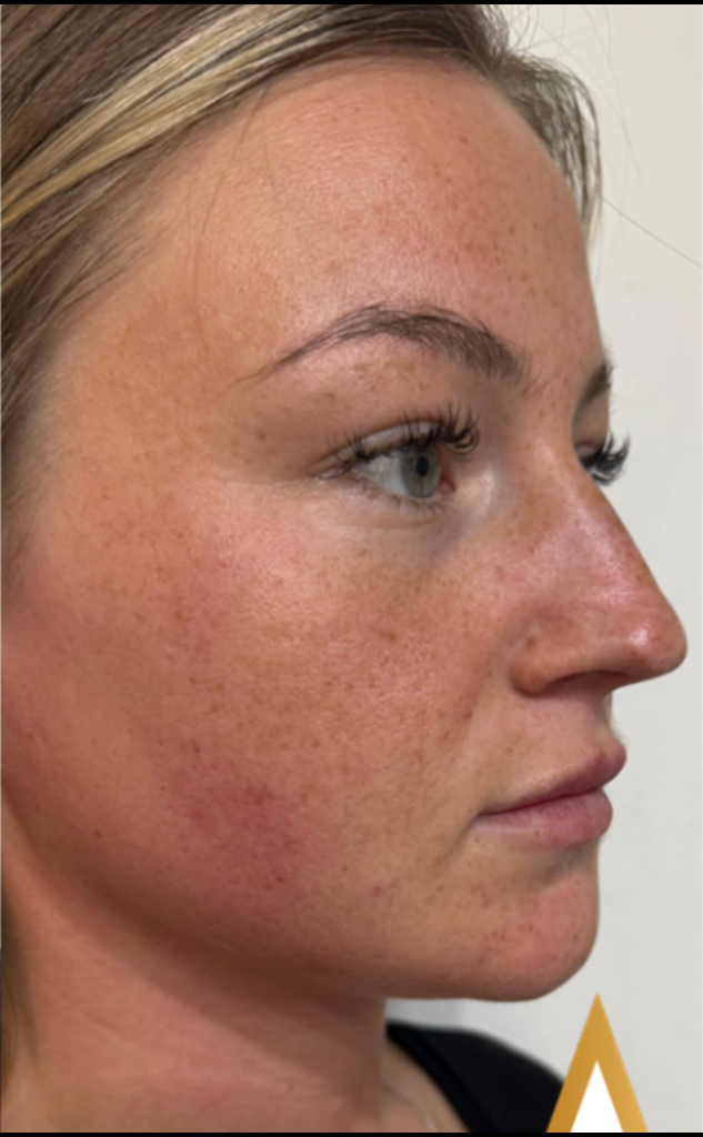 Microdermabrasion after