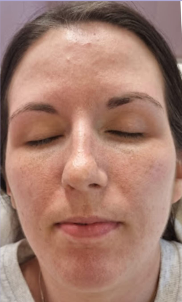 Microdermabrasion after
