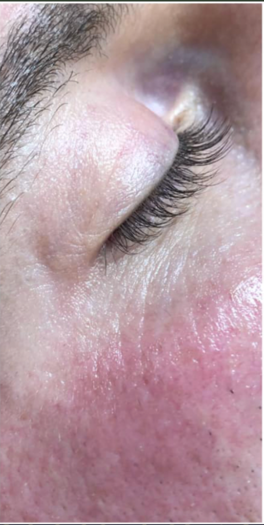 Crow's Feet after