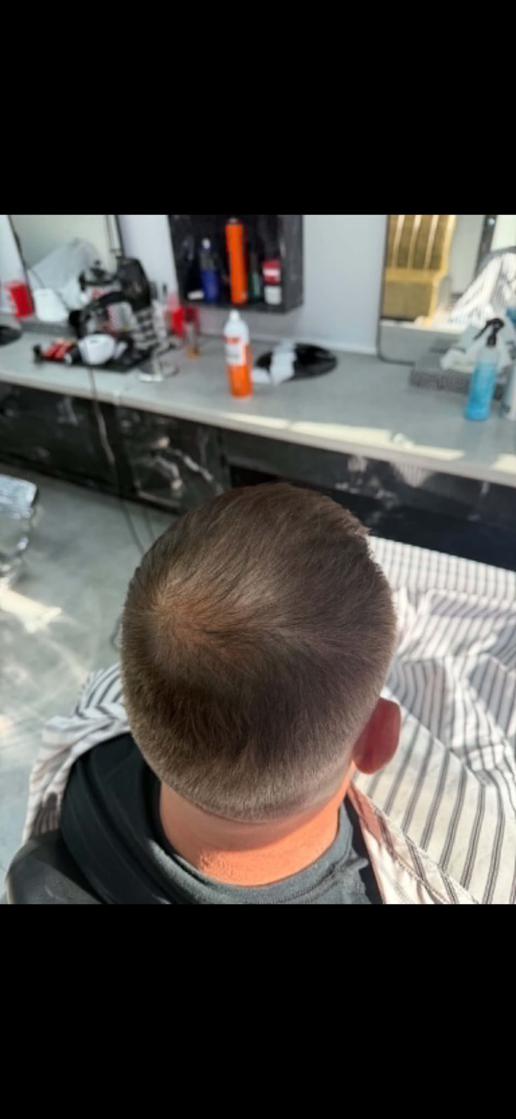 Exobloom Scalp Crown Density after