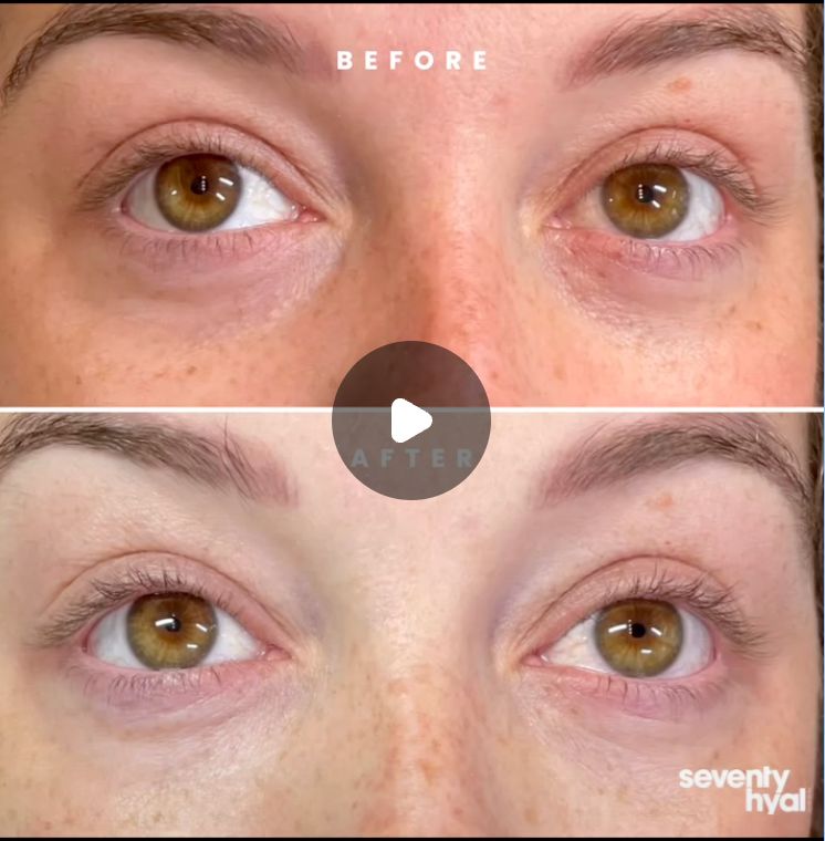 Under-Eye Refresh before and after