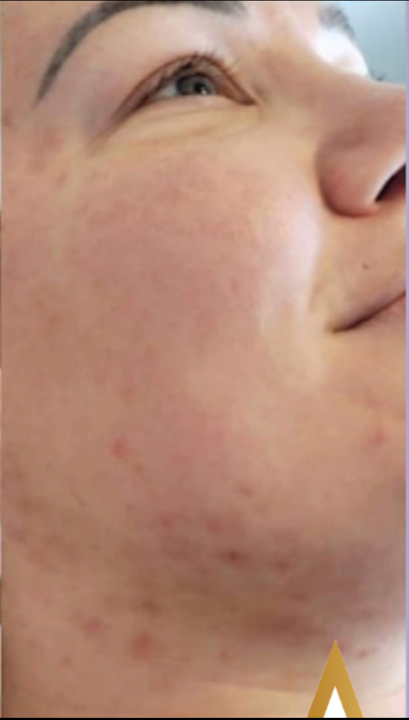 Microdermabrasion after
