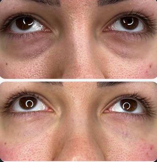 Lower Eye Rejuvenation before and after