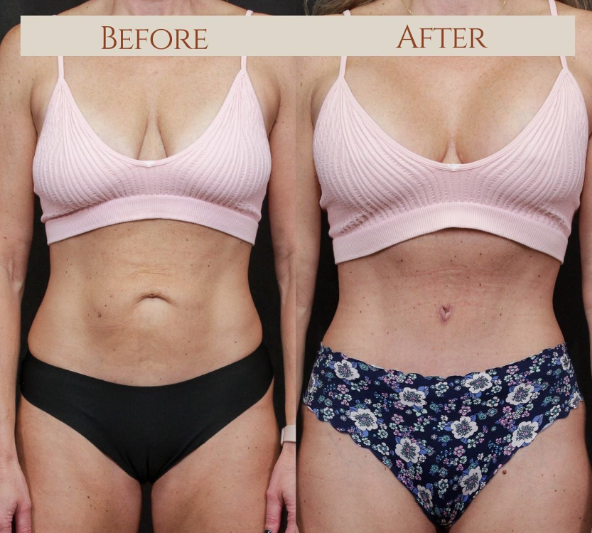 Tummy Tuck / Abdominoplasty