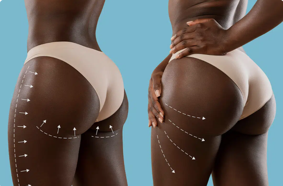 Buttock Enhancement
