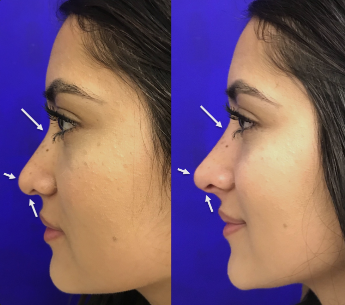 Non-Surgical Nose Enhancement