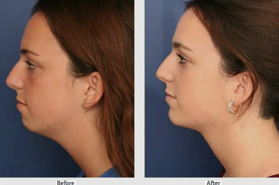 Facial Cosmetic Surgery