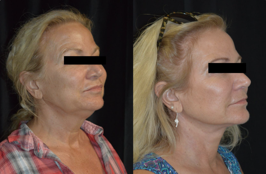 Face & Neck Lift